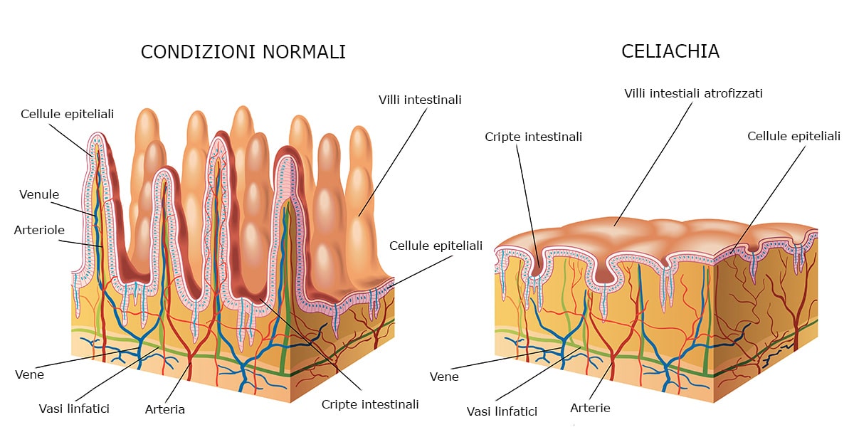 differenza tra villi intestinali atrofizzati e sani